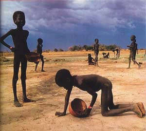 Image result for Malnutrition in mali