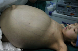 11-year-old Han Bingbing underwent eight hours of surgery to remove a 33 pound tumor from her abdomen. 11-year-old Han Bingbing underwent eight hours of surgery to remove a 33 pound tumor from her abdomen.