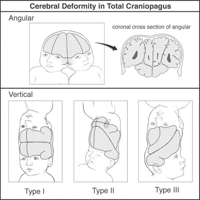 Cerebral Deformity in Total Craniopagus. Cerebral Deformity in Total Craniopagus.