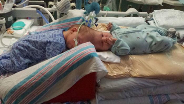 They were born like any other babies - just conjoined. They were born like any other babies - just conjoined.