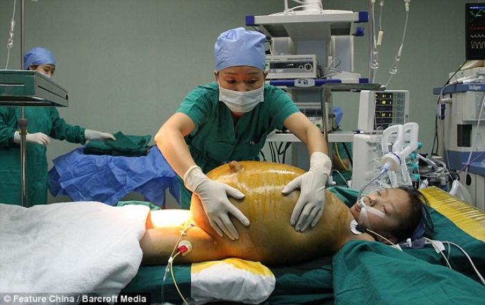 11-year-old Han Bingbing underwent eight hours of surgery to remove a 33 pound tumor from her abdome 11-year-old Han Bingbing underwent eight hours of surgery to remove a 33 pound tumor from her abdome