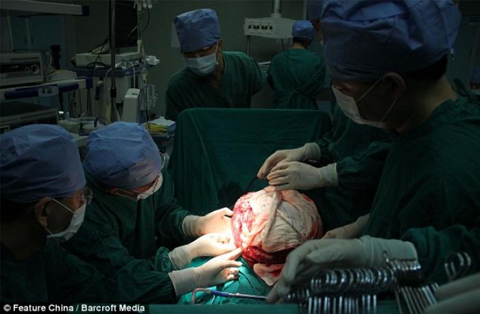 11-year-old Han Bingbing underwent eight hours of surgery to remove a 33 pound tumor from her abdome 11-year-old Han Bingbing underwent eight hours of surgery to remove a 33 pound tumor from her abdome