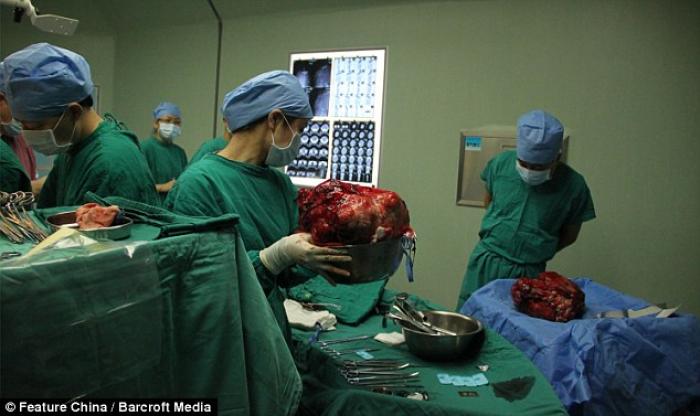 11-year-old Han Bingbing underwent eight hours of surgery to remove a 33 pound tumor from her abdome 11-year-old Han Bingbing underwent eight hours of surgery to remove a 33 pound tumor from her abdome