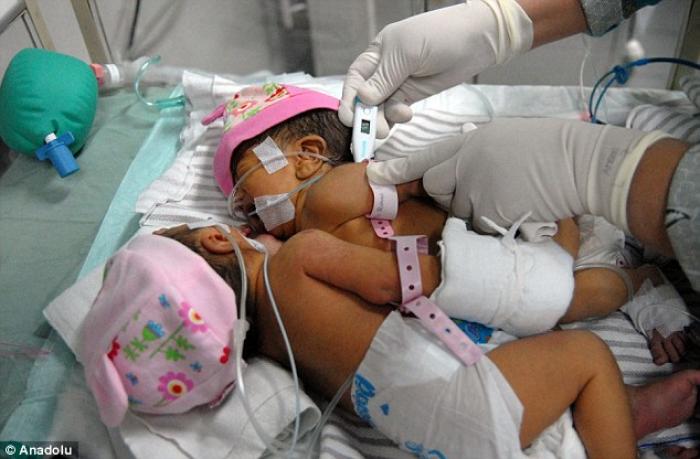 Rare Conjoined Twins Born In Indonesia With Attached Chest