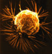 Cancer cells like this one may soon be cured with the help of a genetically engineered virus. Image of Cancer cells like this one may soon be cured with the help of a genetically engineered virus.
