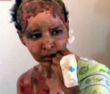 Shweyga Mullah recounts to reporters how she was cruelly burned by Aline Gaddafi. Image of Shweyga Mullah recounts to reporters how she was cruelly burned by Aline Gaddafi.