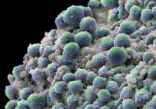 Prostate cancer cells. The quiz will give men a better idea of what to expect after they beat cancer. Image of Prostate cancer cells. The quiz will give men a better idea of what to expect after they beat cancer.