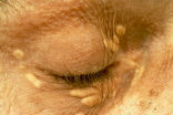 Xanthelasmata is an indicator of a deadly condition. Image of Xanthelasmata is an indicator of a deadly condition.