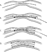 This diagram shows how the Gateway-Wingspan stent is intended to work. Image of This diagram shows how the Gateway-Wingspan stent is intended to work.