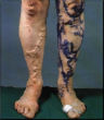 An extreme case of varicose veins. Image of An extreme case of varicose veins.