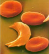 A misshapen sickle cell as imaged under a microscope. Image of A misshapen sickle cell as imaged under a microscope.