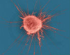 Beta blockers may stop the spread of breast cancer cells. Image of Beta blockers may stop the spread of breast cancer cells.