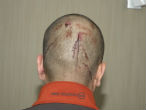 This image shows that Zimmerman clearly sustained injuries to the back of his head. Image of This image shows that Zimmerman clearly sustained injuries to the back of his head.