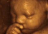 3D/4D Ultrasound Image of 3D/4D Ultrasound