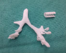 A picture of the implant created for baby Kaiba on a 3D printer. Image of A picture of the implant created for baby Kaiba on a 3D printer.