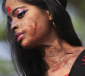 About 90 percent of acid attack victims are women and children. Image of About 90 percent of acid attack victims are women and children.