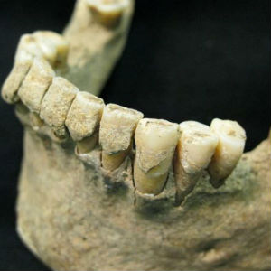 Gum disease is caused by a build-up of plaque on the teeth. Plaque is a sticky substance that contains bacteria. When it hardens, it forms tartar. Gum disease is caused by a build-up of plaque on the teeth. Plaque is a sticky substance that contains bacteria. When it hardens, it forms tartar.