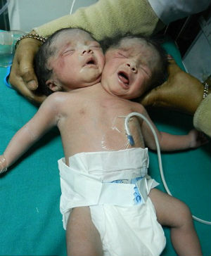Conjoined twins who share a single body have dicephalic parapagus - an extremely unusual form of conjoinment. Conjoined twins who share a single body have dicephalic parapagus - an extremely unusual form of conjoinment.
