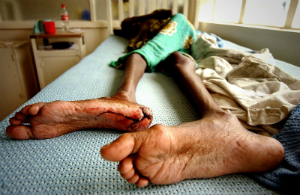 MDR-TB is a major killer and when it combines with diseases such as HIV, there is no chance of survival. MDR-TB is a major killer and when it combines with diseases such as HIV, there is no chance of survival.