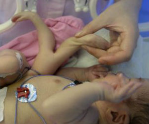 The conjoined twins weighed just over three kilograms before surgery, with the removed parasitic fetus weighing 0.6kg. The conjoined twins weighed just over three kilograms before surgery, with the removed parasitic fetus weighing 0.6kg.
