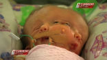 The conjoined twins, Faith and Hope, suffer from a rare condition where they have two separate brains and faces, but share a head and body. Image of The conjoined twins, Faith and Hope, suffer from a rare condition where they have two separate brains and faces, but share a head and body.