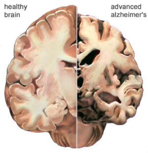 A healthy brain section (left) next to a section that has been ravaged by Alzheimer's disease (right). A healthy brain section (left) next to a section that has been ravaged by Alzheimer's disease (right).