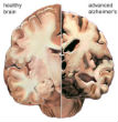 A healthy brain section (left) next to a section that has been ravaged by Alzheimer's disease (right). Image of A healthy brain section (left) next to a section that has been ravaged by Alzheimer's disease (right).