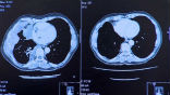 Image scans of Steele's lungs before and after his treatment. The left scan shows numerous gray colored cancer tissues, which are gone in the right, after his treatment. Image of Image scans of Steele's lungs before and after his treatment. The left scan shows numerous gray colored cancer tissues, which are gone in the right, after his treatment.