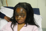 Losing her eyelids, eyebrows and being disfigured by acid thrown on her by Mary Konye, Noami Oni is looking for love after two years of reconstructive surgery. Image of Losing her eyelids, eyebrows and being disfigured by acid thrown on her by Mary Konye, Noami Oni is looking for love after two years of reconstructive surgery.