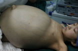 11-year-old Han Bingbing underwent eight hours of surgery to remove a 33 pound tumor from her abdomen. Image of 11-year-old Han Bingbing underwent eight hours of surgery to remove a 33 pound tumor from her abdomen.