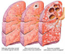 Tuberculosis is a disease which slowly destroys the lungs of the infected person. Around 50% of those whose tuberculosis becomes active die if untreated. Image of Tuberculosis is a disease which slowly destroys the lungs of the infected person. Around 50% of those whose tuberculosis becomes active die if untreated.