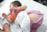 This Chinese baby boy was born with a tumor at the base of his spine, which has now grown to the size of a melon. Image of This Chinese baby boy was born with a tumor at the base of his spine, which has now grown to the size of a melon.