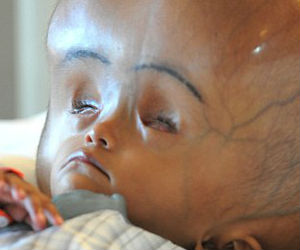 Surgeons carried out a series of operations to reduce the size of Roona's head. Sent home after surgery, her parents were warned she had little chance of survival. Surgeons carried out a series of operations to reduce the size of Roona's head. Sent home after surgery, her parents were warned she had little chance of survival.