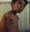Tuberculosis, also known as the Image of Tuberculosis, also known as the
