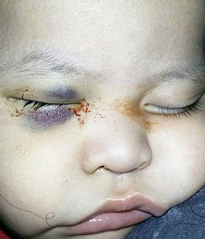 One-year-old Fernando Jonathan Valdez Ayala was undergoing chemotherapy to treat a tumor in his left eye. Surgeon Armando Cisneros Espinoza decided the treatment was not working. One-year-old Fernando Jonathan Valdez Ayala was undergoing chemotherapy to treat a tumor in his left eye. Surgeon Armando Cisneros Espinoza decided the treatment was not working.