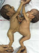 Jannat and Mannat were born with omphalopaygus, a condition where twins are joined at the abdomen and lower chest (Barcroft India). Image of Jannat and Mannat were born with omphalopaygus, a condition where twins are joined at the abdomen and lower chest (Barcroft India).