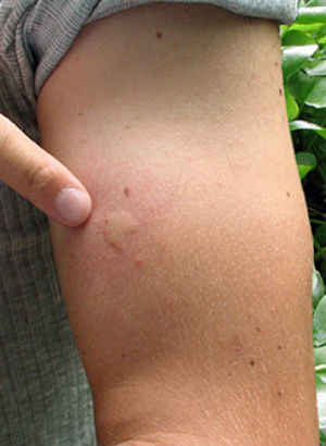'Scarier than we initially thought': CDC discovers frightening details about the Zika virus - Health & Wellness - News - Vimarsana News