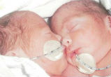 Doctors believed the twins wouldn't survive (PA). Image of Doctors believed the twins wouldn't survive (PA).