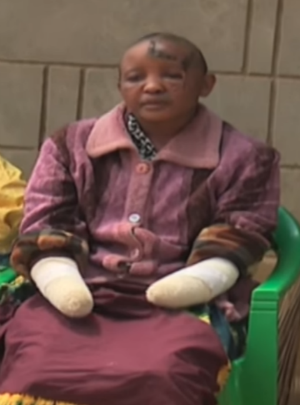 Her husband was frustrated when she did not become pregnant so he chopped off her hands with a machete. Her husband was frustrated when she did not become pregnant so he chopped off her hands with a machete.
