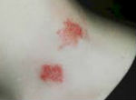Teen dies after hickey leads to deadly blood clot. Image of Teen dies after hickey leads to deadly blood clot.