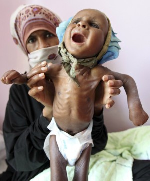 There is a frightening rise in malnourished babies. There is a frightening rise in malnourished babies.