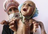 There is a frightening rise in malnourished babies. Image of There is a frightening rise in malnourished babies.