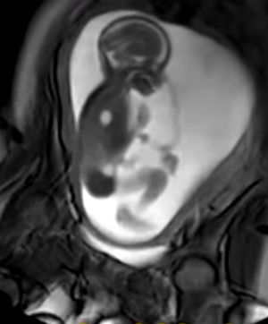 MRI – magzat képe