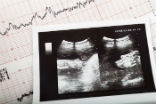 Cardiogram ultrasound baby pregnant Image of Cardiogram ultrasound baby pregnant