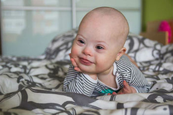 Baby with Down Syndrome Baby with Down Syndrome