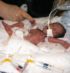 PREMATURE - Mairead Catherine Molloy was born more than three months early, weighing less than 2 pounds. She spent much of the first months of her life hooked up to machines to feed her and help her breathe. Image of PREMATURE - Mairead Catherine Molloy was born more than three months early, weighing less than 2 pounds. She spent much of the first months of her life hooked up to machines to feed her and help her breathe.