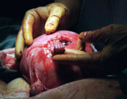 Tremendous advances in our ability to provide Surgical help for children in the womb is showing the humanity of the unborn child and offering significant assistance to the Pro-Life cause. Image of Tremendous advances in our ability to provide Surgical help for children in the womb is showing the humanity of the unborn child and offering significant assistance to the Pro-Life cause.