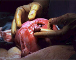 Samuel Armas still has strong hands. Here he is pictured during his first surgery which took place in the womb. Today, nine years later, he is fond of white water rafting.He is also happy to have become a symbol of the truth about the Right to Life. Image of Samuel Armas still has strong hands. Here he is pictured during his first surgery which took place in the womb. Today, nine years later, he is fond of white water rafting.He is also happy to have become a symbol of the truth about the Right to Life.