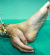 A Chinese man had to have his hand attached to his ankle after severing it off his arm. Image of A Chinese man had to have his hand attached to his ankle after severing it off his arm.
