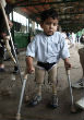 A young boy struck by a sitting mine. Image of A young boy struck by a sitting mine.